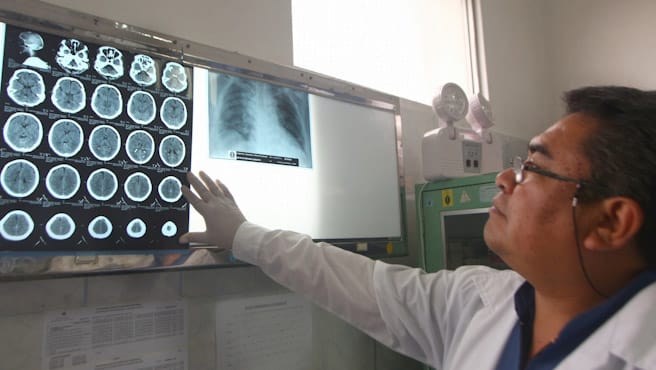 accidente cerebrovascular (ACV)