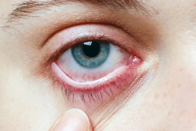 Síndrome de ojo seco